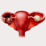 Эндометриоидные кисты яичников